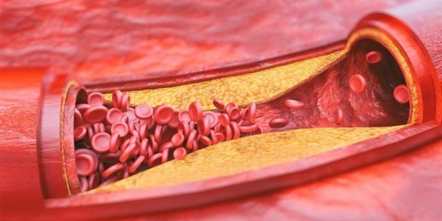 عوامل مختلفة تؤدى إلى الإصابة بتصلب الشرايين، تعرف عليها